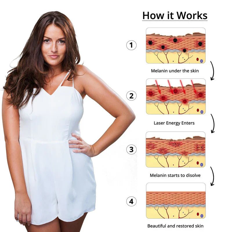 Tattoo Removal Laser image 5