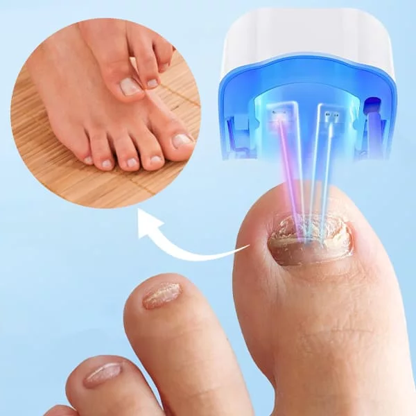 Nail Fungus Cleaning Laser Device image 3