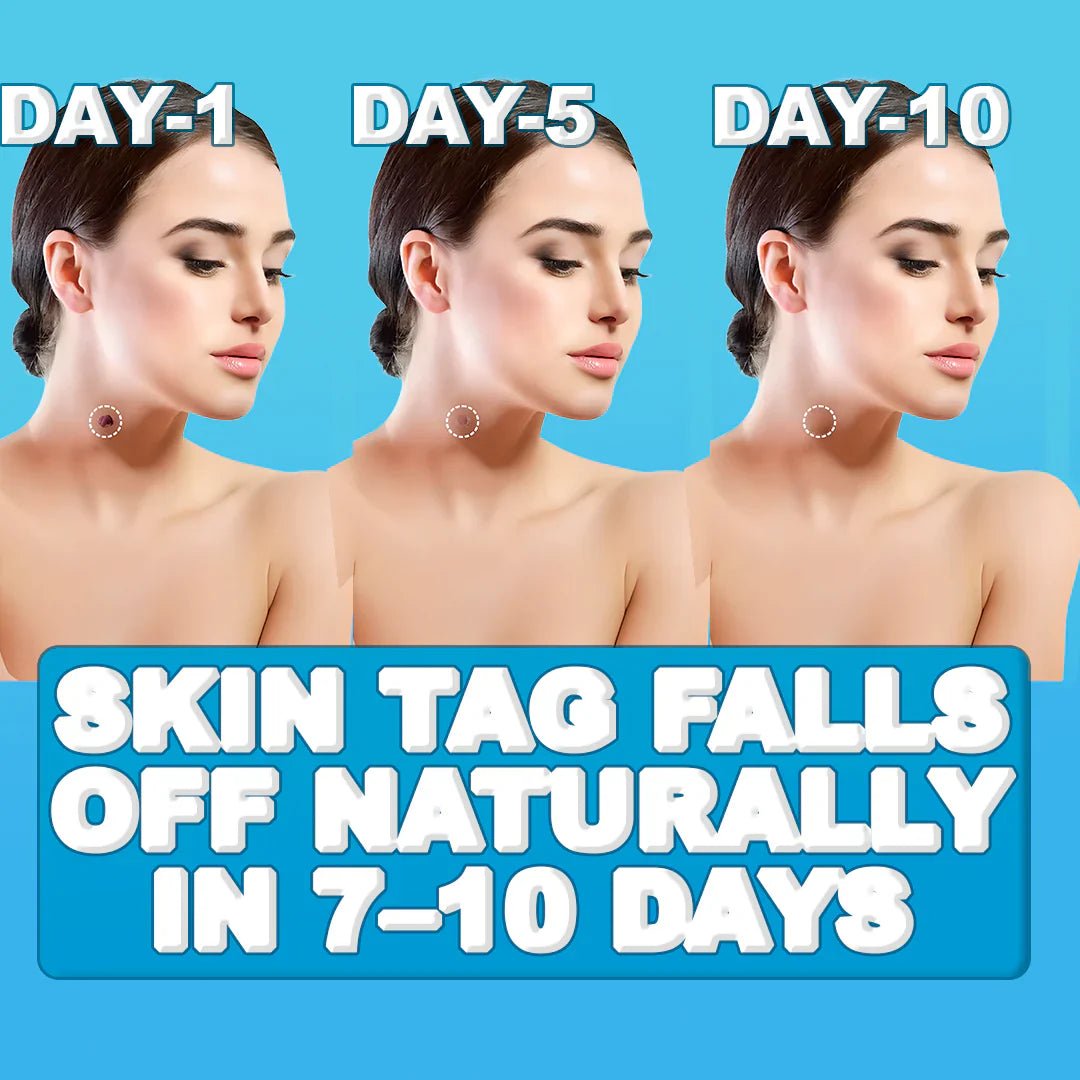 Painless Skin Tag Remover image 6