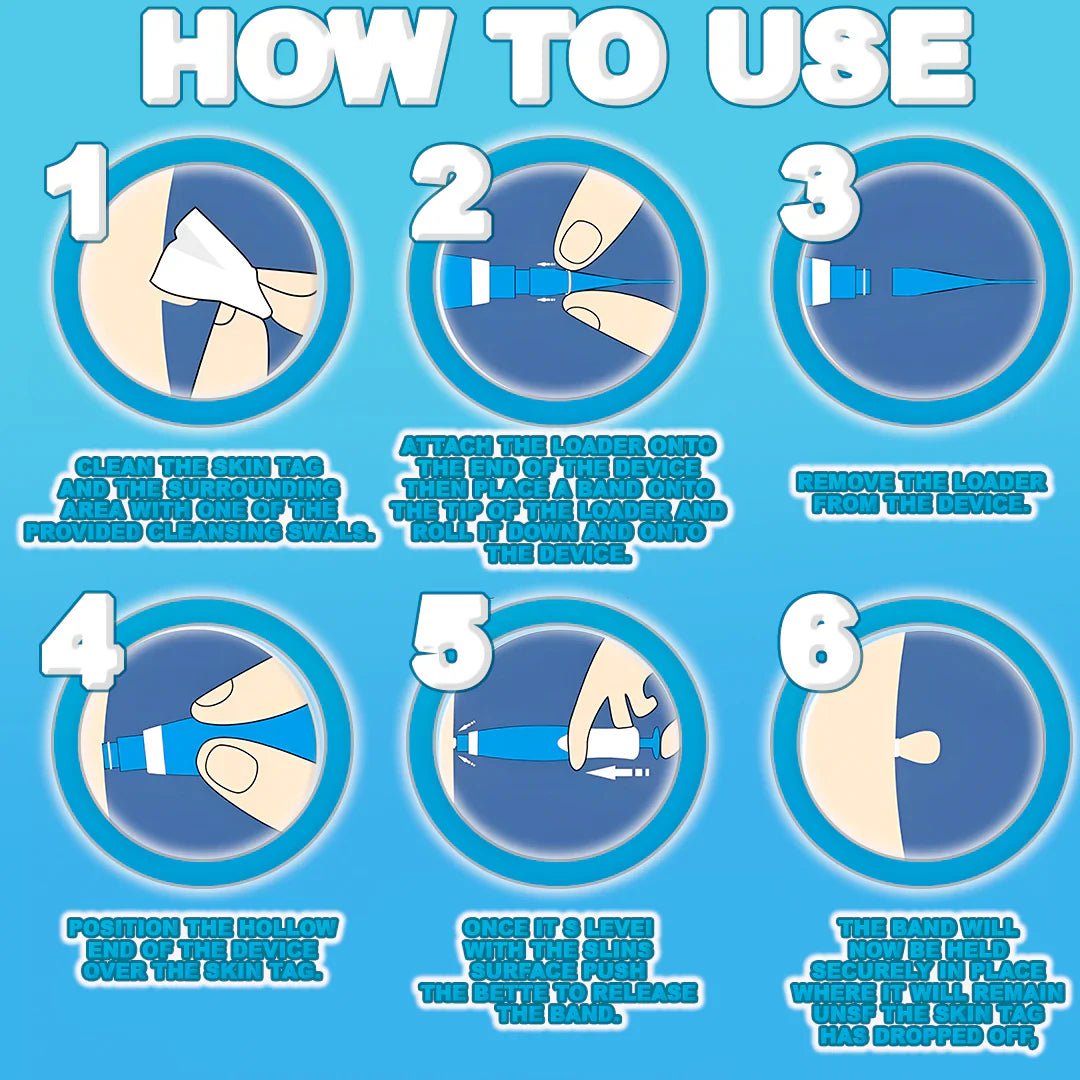 Painless Skin Tag Remover image 4