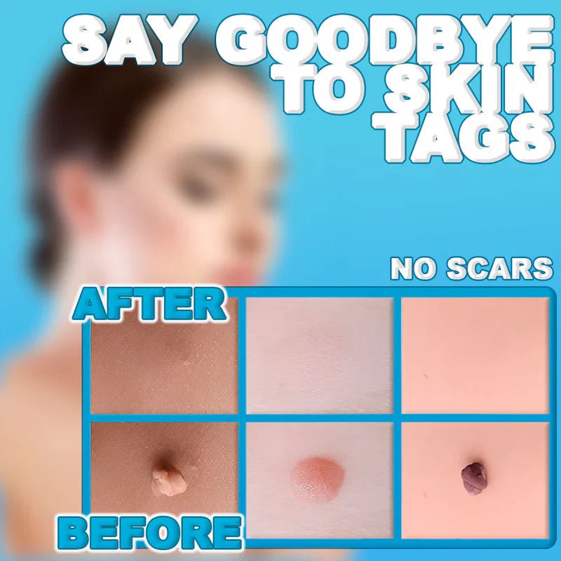 Painless Skin Tag Remover image 1