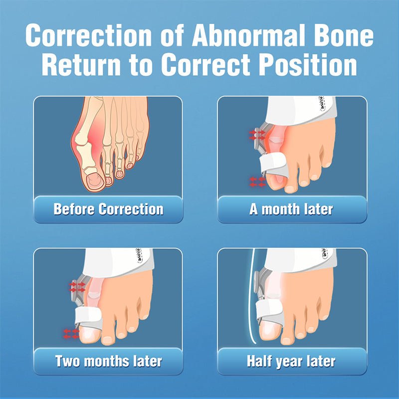 Upgraded Bunion Corrector - 3D Knob Toe Corrector image 7