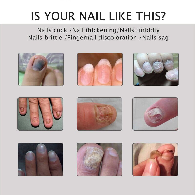 Nail Repair Treatment Gel - Image 4